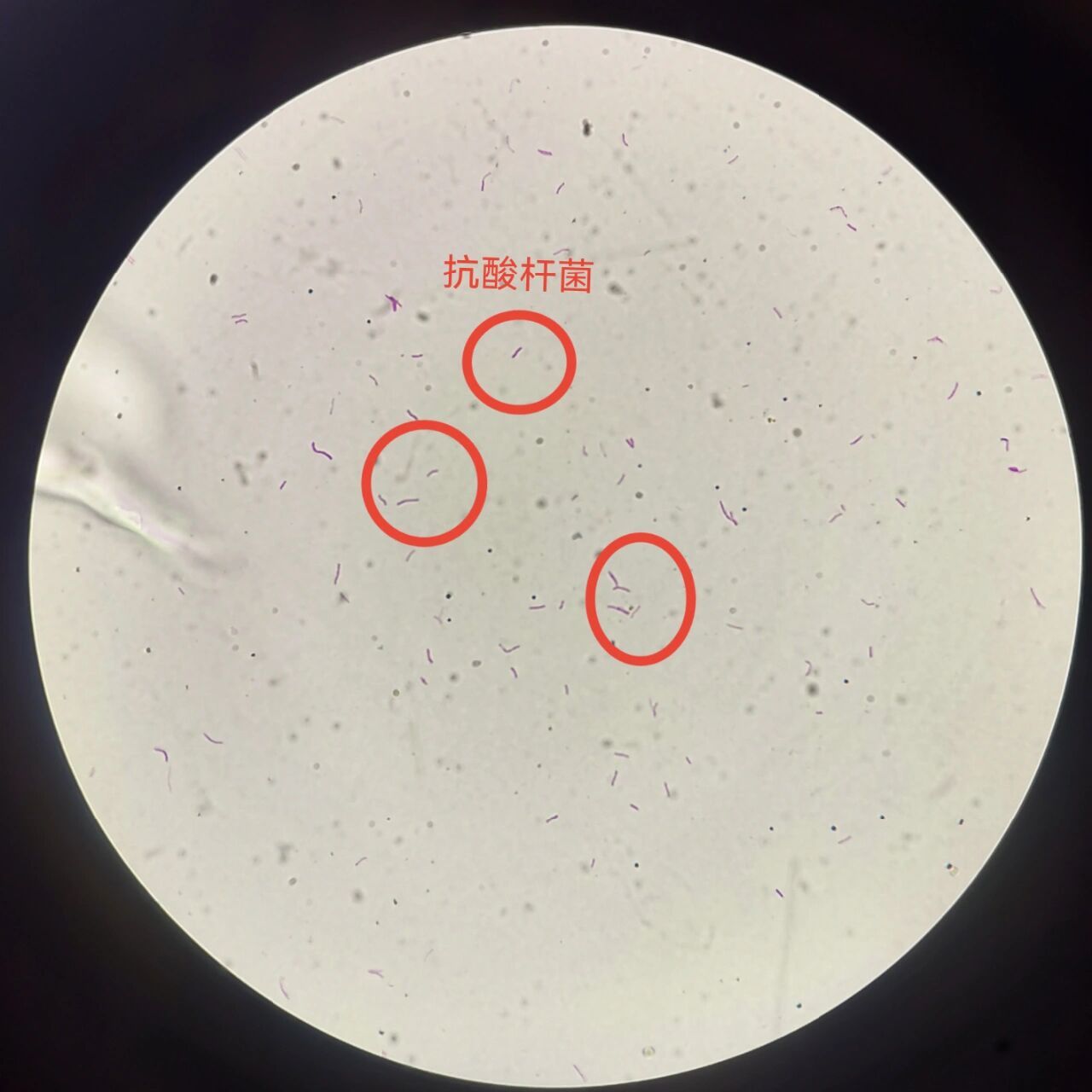 抗酸染色阳性 可见红色抗酸杆菌 👉临床上主要用于结核病,麻风病等