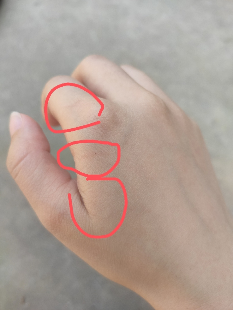 在线等急,被猫抓伤了 刚刚手贱去撩猫,结果手被爪子抓到了,破了一点皮