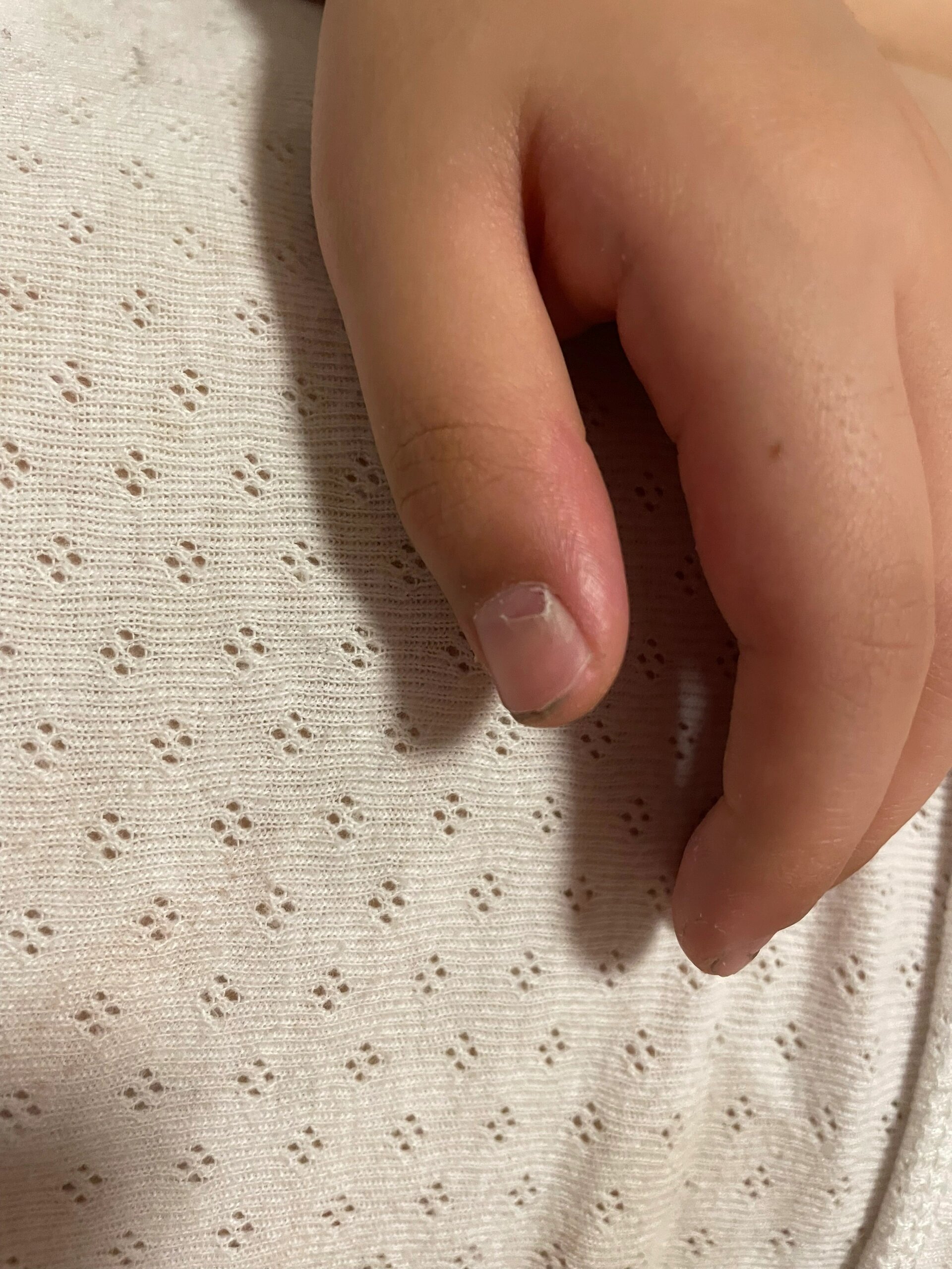 还有谁不知道宝宝指甲分层脱落的原因