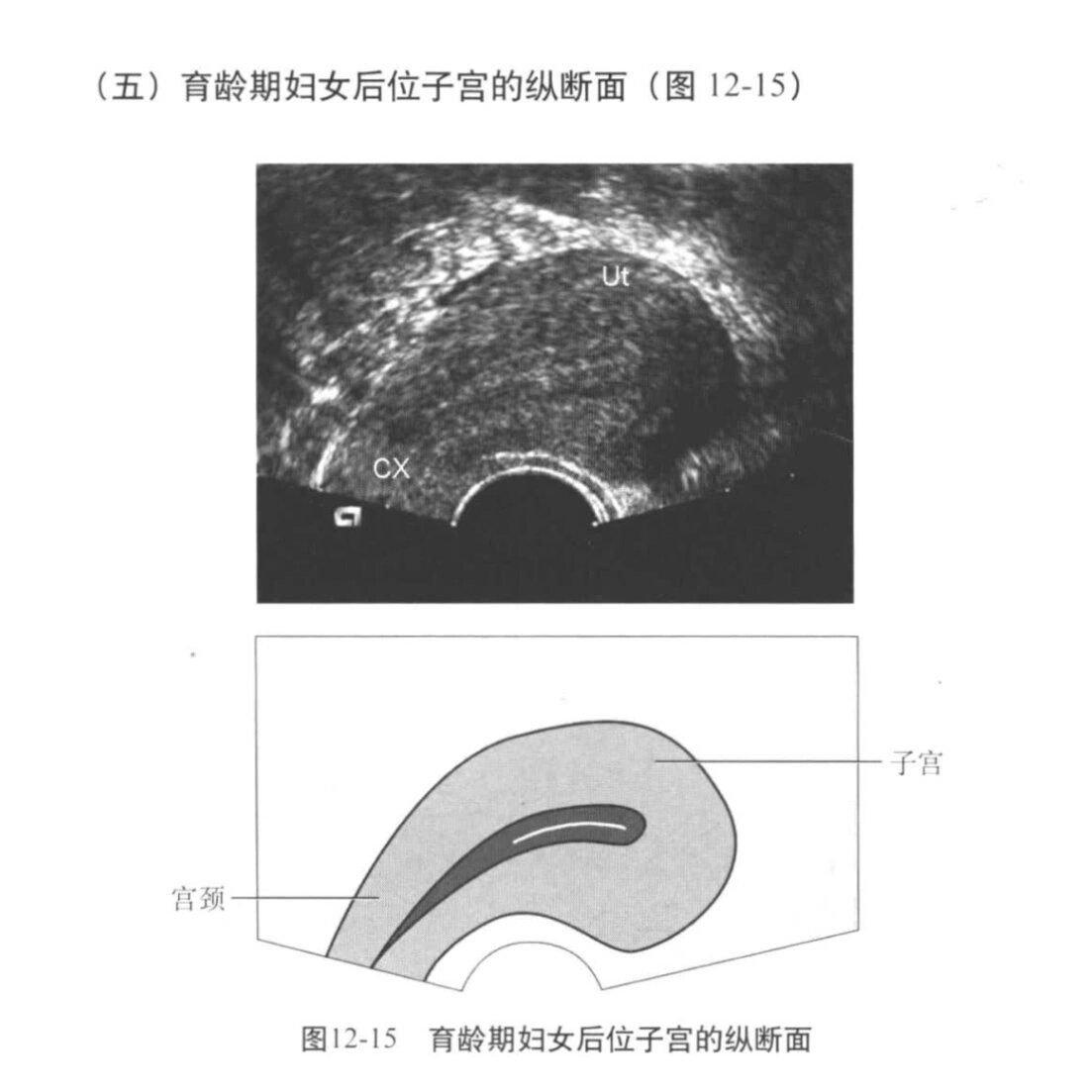 30超声学习打卡第6day,子宫前后位的判断 子宫前位