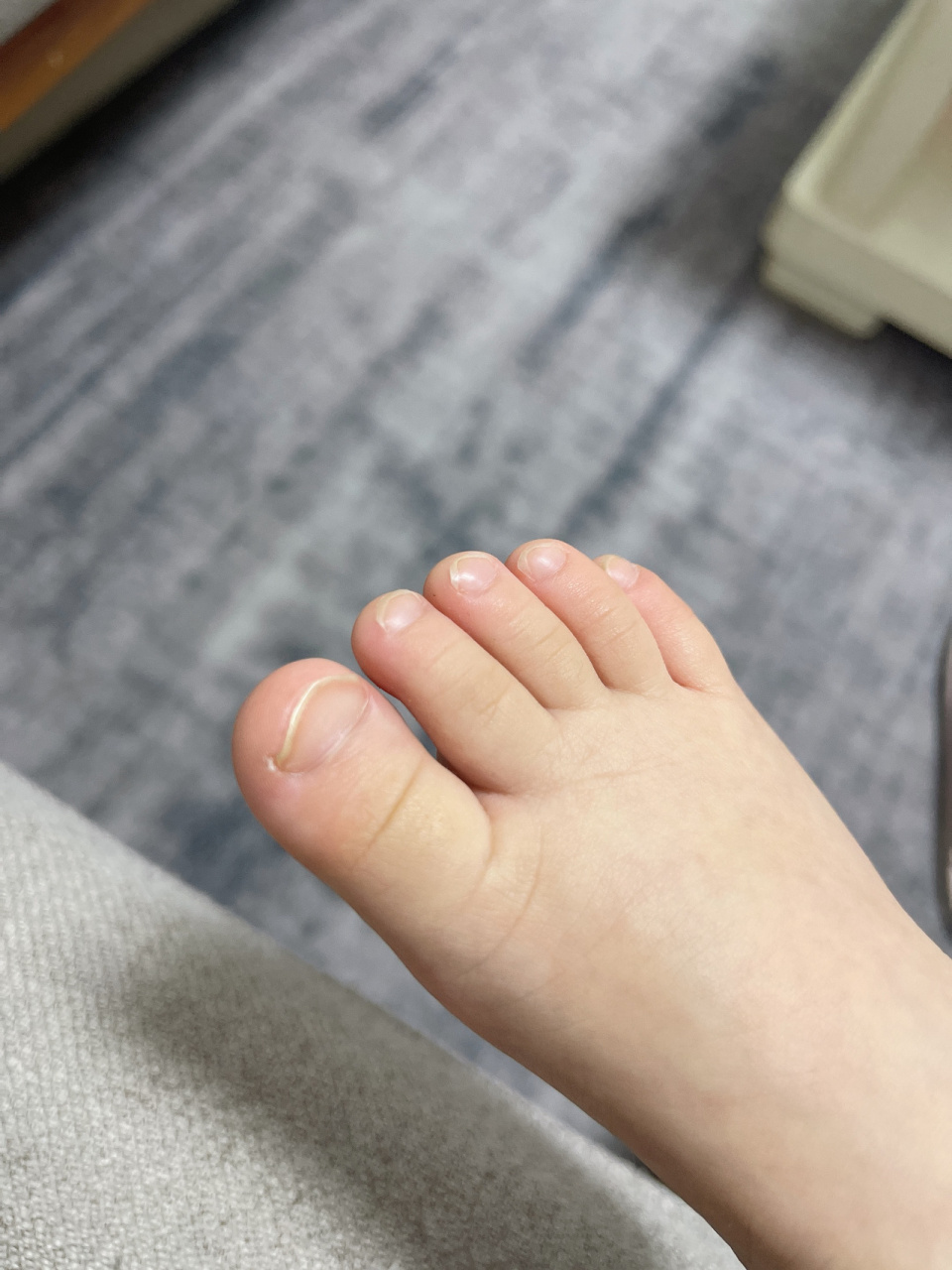 小朋友的大拇指指甲总是两边翘 出生后一直是两边翘翘,不知道有没有一