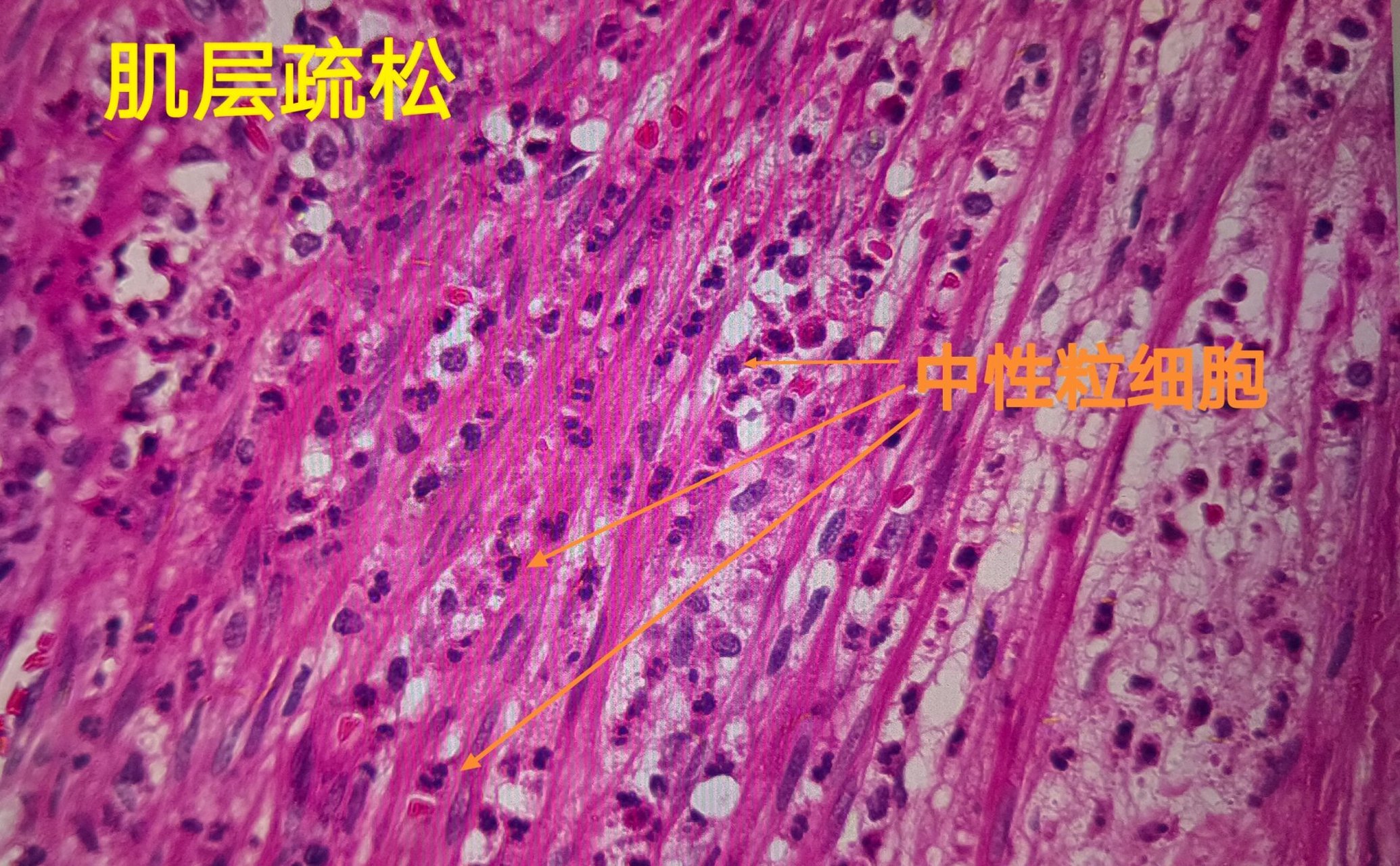 急性蜂窝织性阑尾炎(镜下)