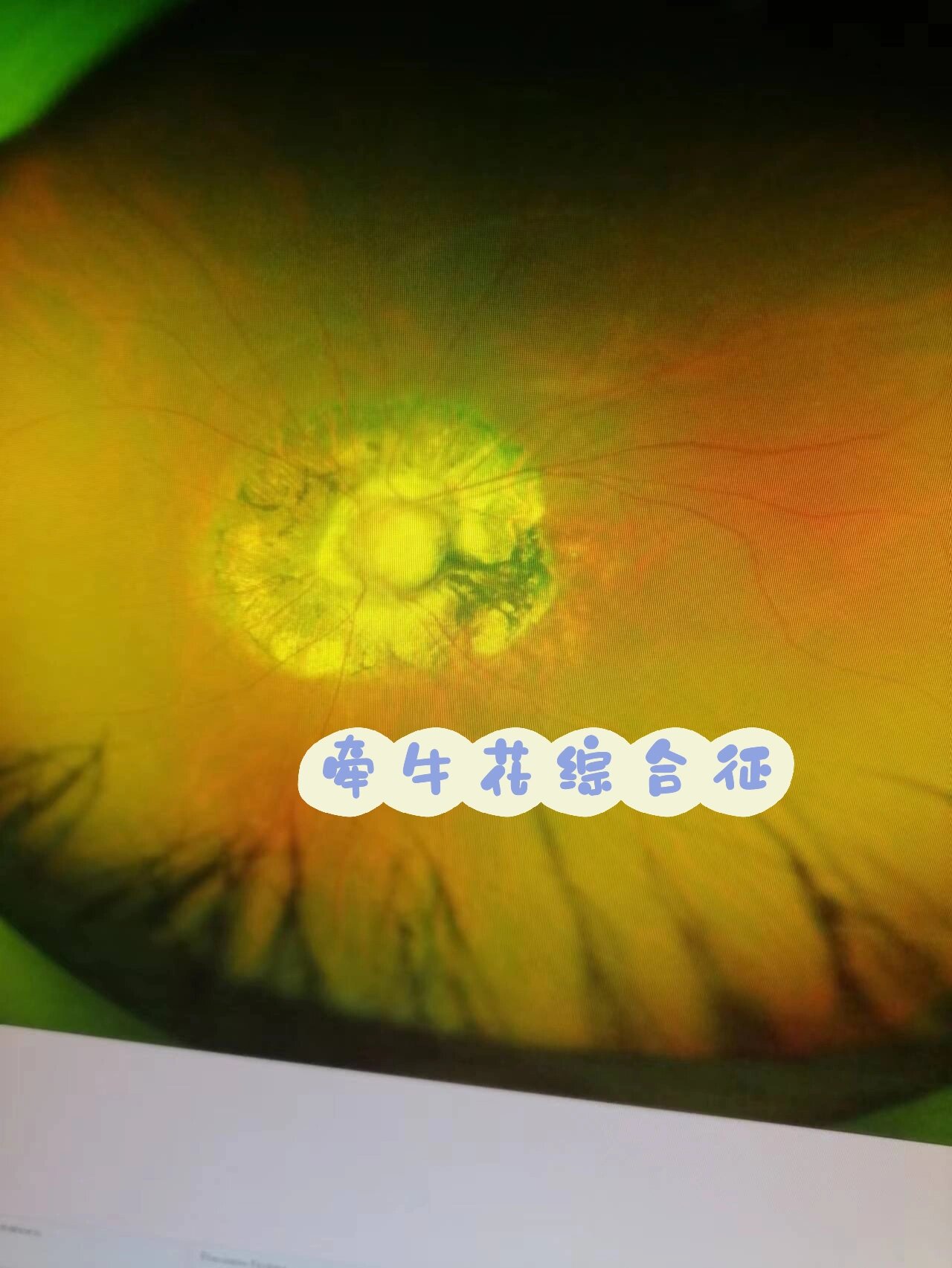 先天性小角膜 牵牛花综合征矫正实例 年龄:41 度数:右眼700近视175