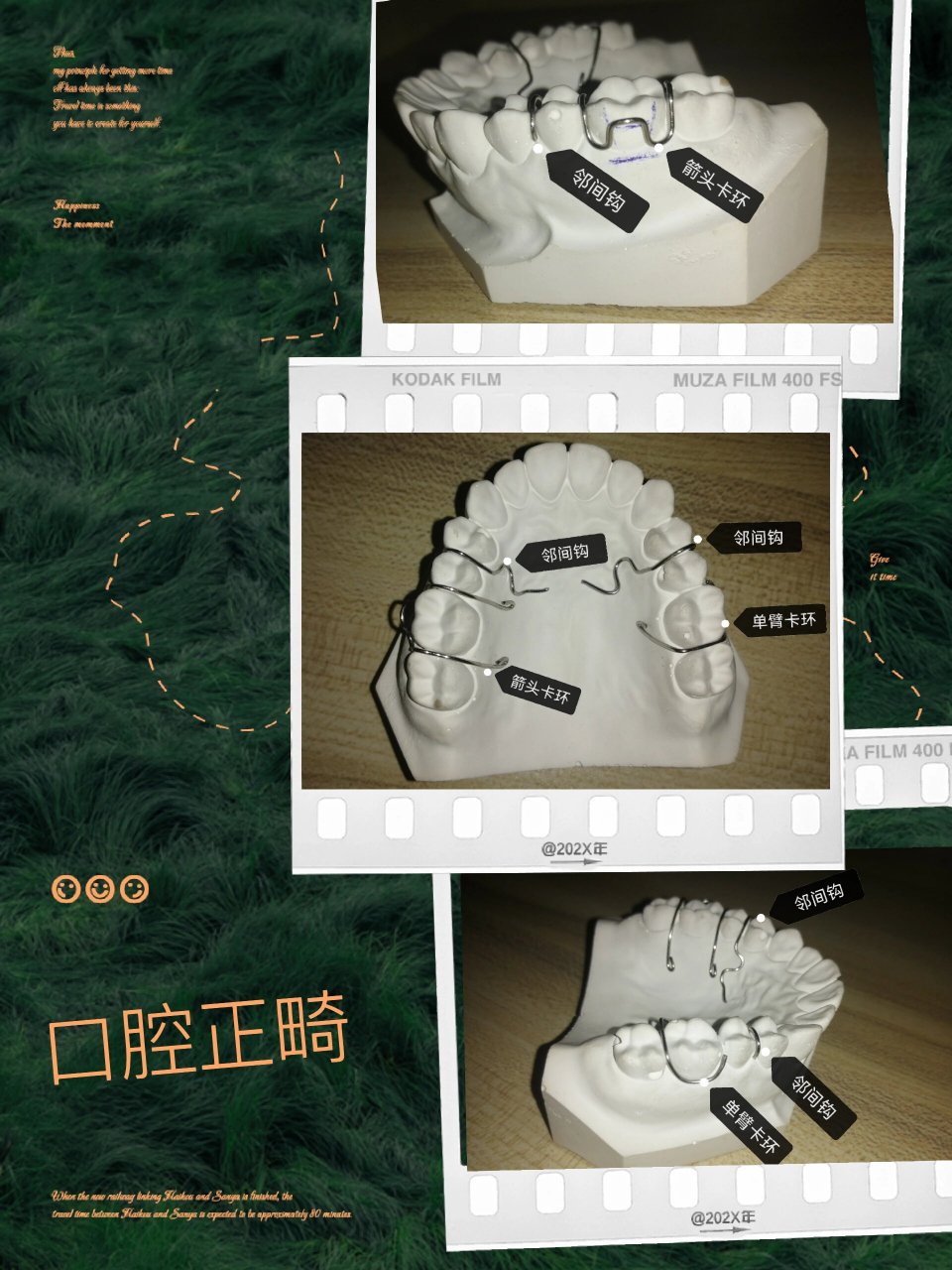 口腔正畸学----卡环 1,箭头卡环 2,单臂卡环 3,邻间钩