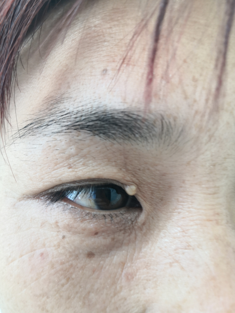 眼睑边缘的粟丘疹症状#美容# 可以使用激光治疗去除.