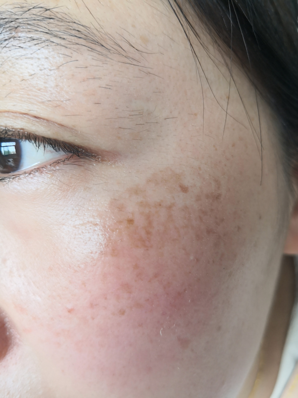 面颊黄褐斑症状.使用药物配合激光治疗后效果不错.