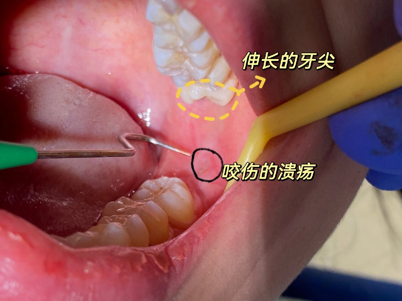 为什么智齿冲洗后更疼了为什么在线 为什么智齿冲洗后更疼了为什么在线