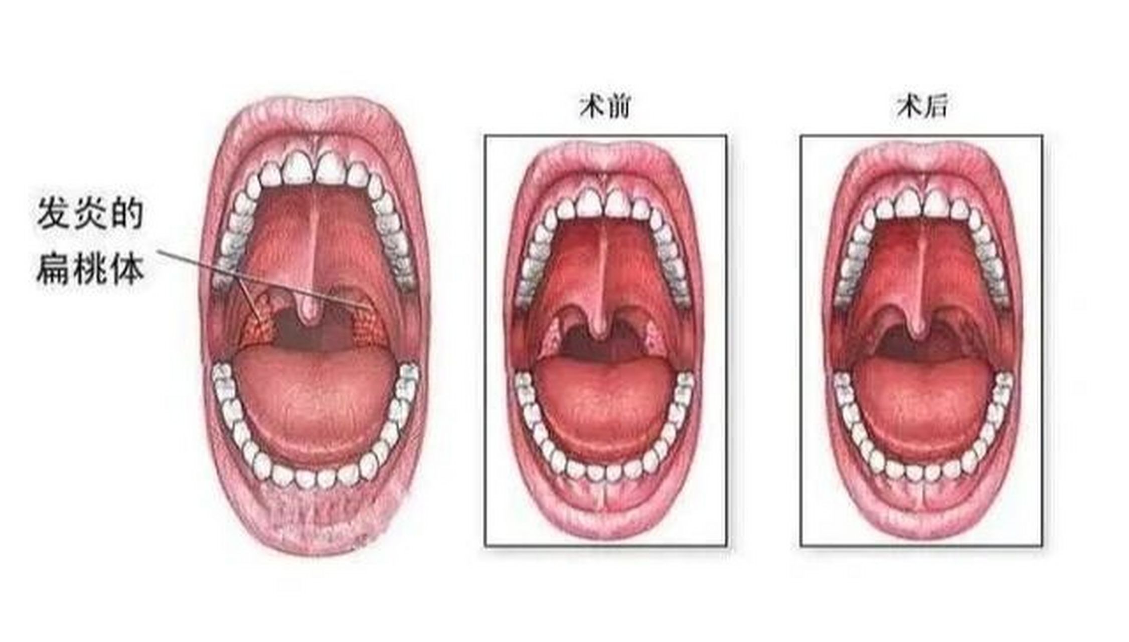 扁桃体炎可致肾病加重,要不要摘除以除后患 哪些肾