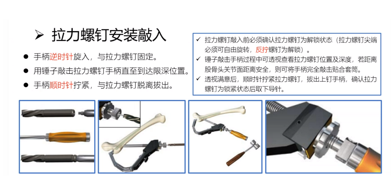 股骨髓内钉(pfna)手术步骤