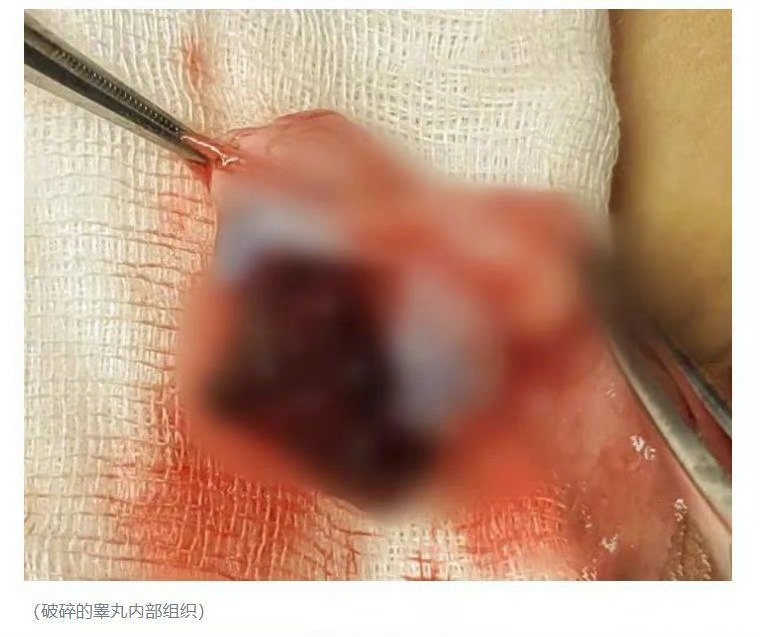 男孩蛋蛋被同学踢碎成果冻#医生称每月接诊二三十例睾丸外伤患儿