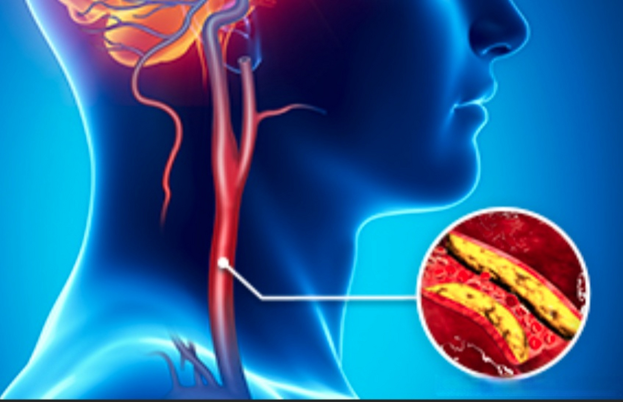 颈动脉斑块的位置图片