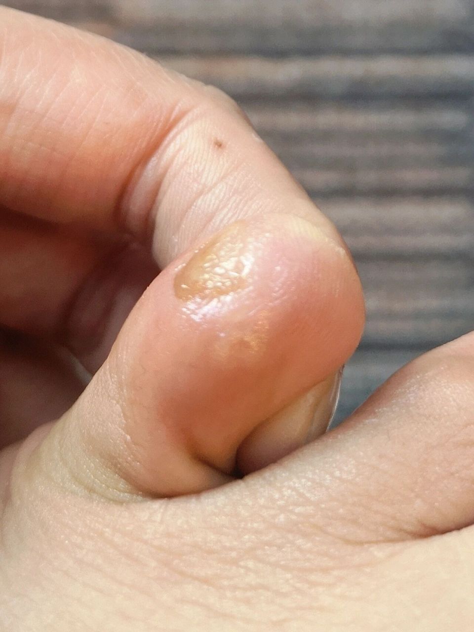 已经不记得什么时候开始,小脚趾头总是反复长鸡眼,一走路就疼母后大人