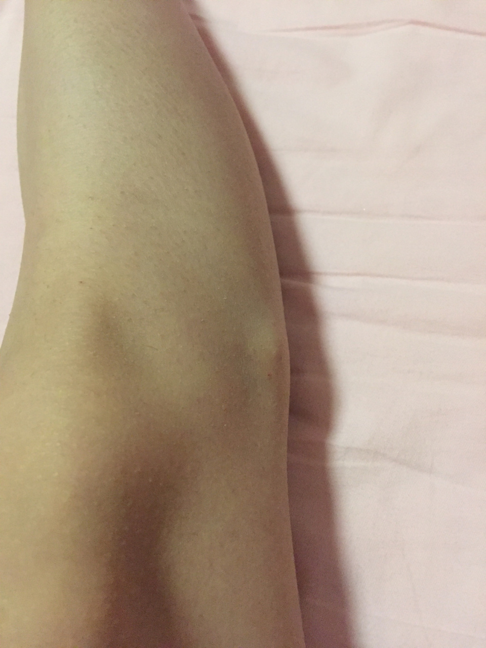 姐妹们,我这个是o型腿吗?膝盖旁边还有突出小骨头,是怎么回事?