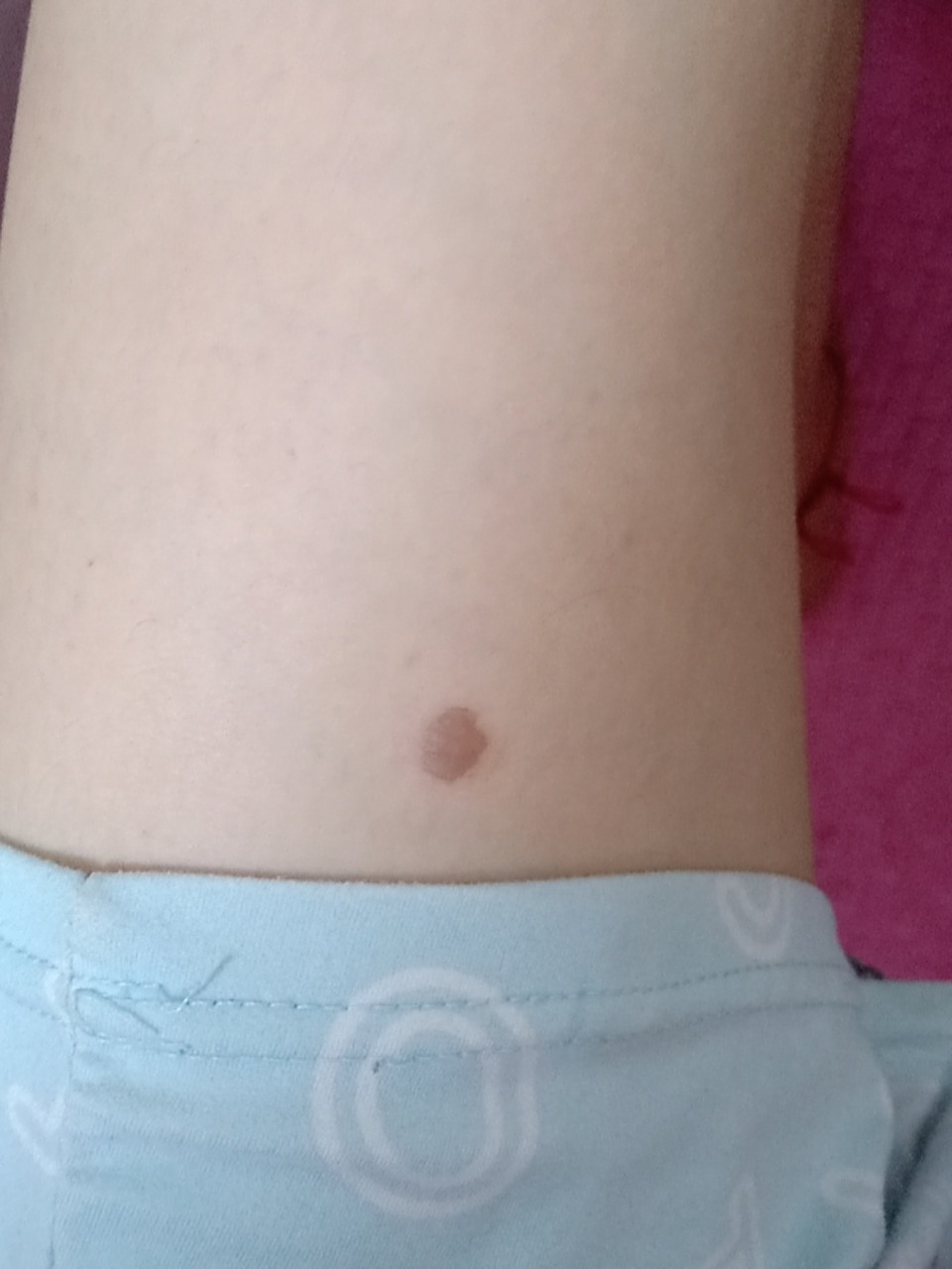 被烟头烫到 前天不小心被烟头烫到了,刚开始没有泡.