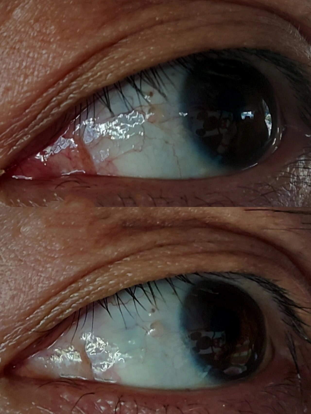 99生理性飞蚊症主要是由于玻璃体浓缩,变性所导致,一般眼部合并