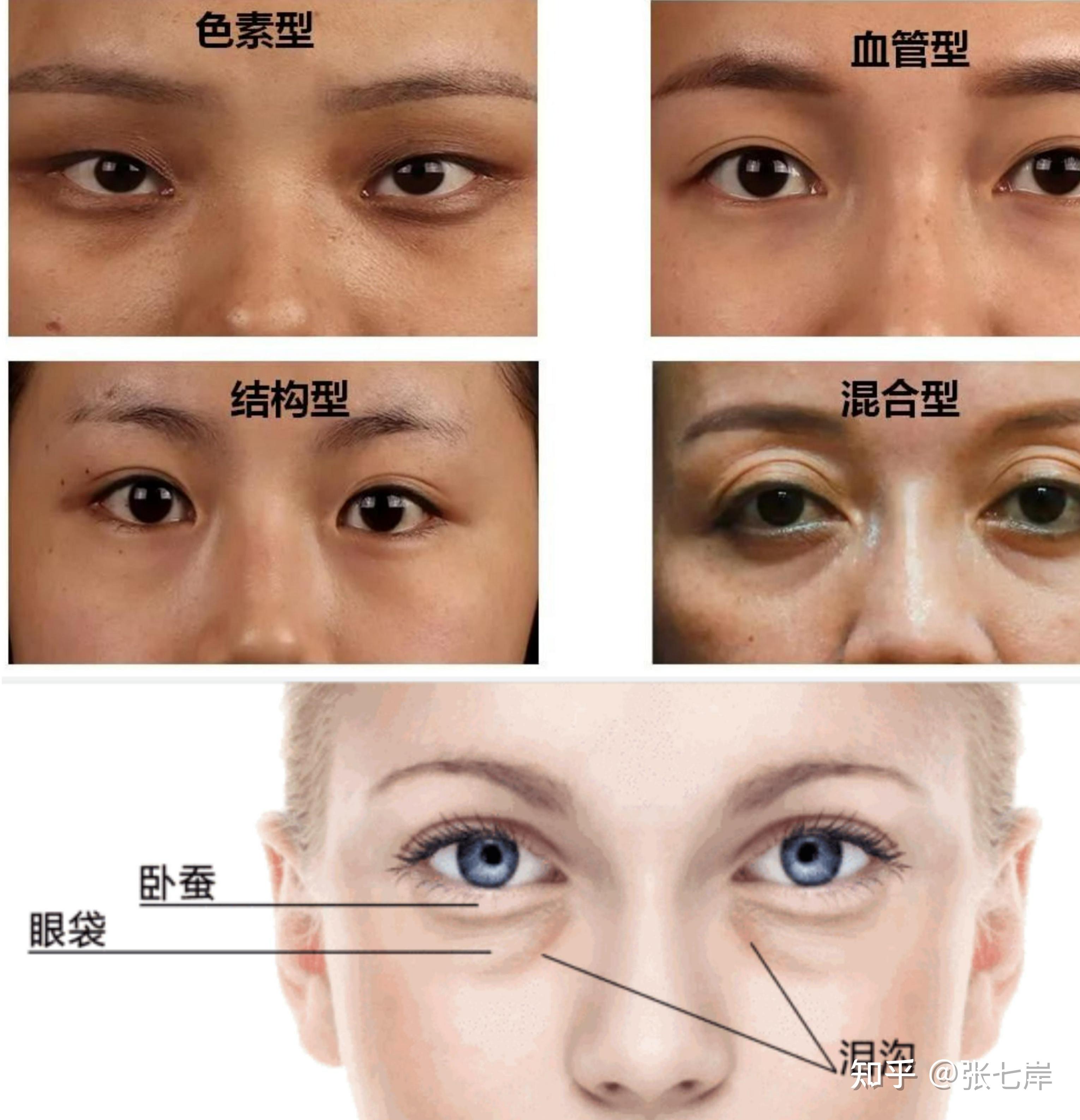 1分钟教你分清黑眼圈泪沟眼袋