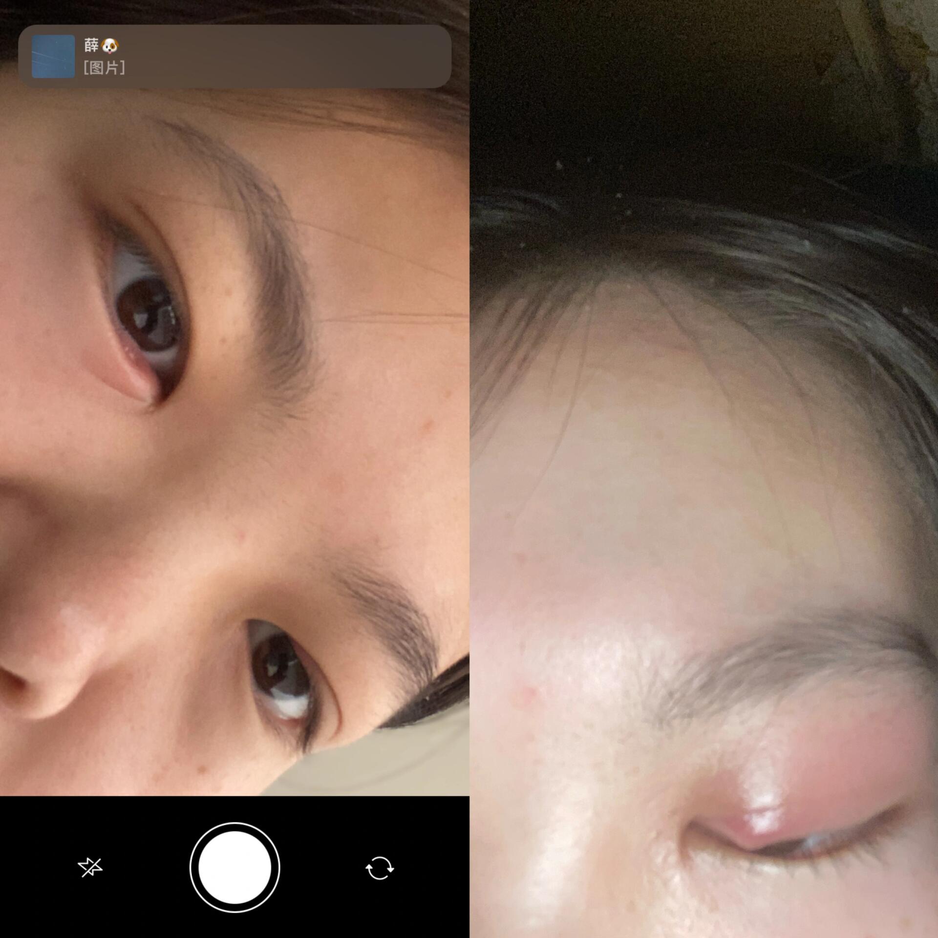 暴发火眼怎么治