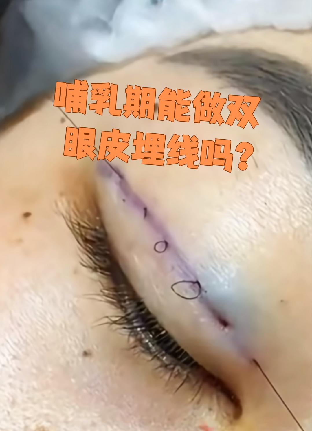 将蛋白线埋入皮下组织来形成双眼皮