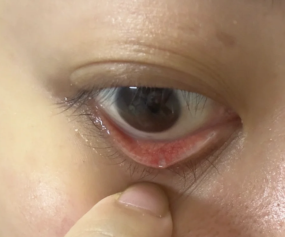 下眼皮里面长小疙瘩常见原因有脂肪粒,麦粒肿,皮脂腺囊肿,睑板腺