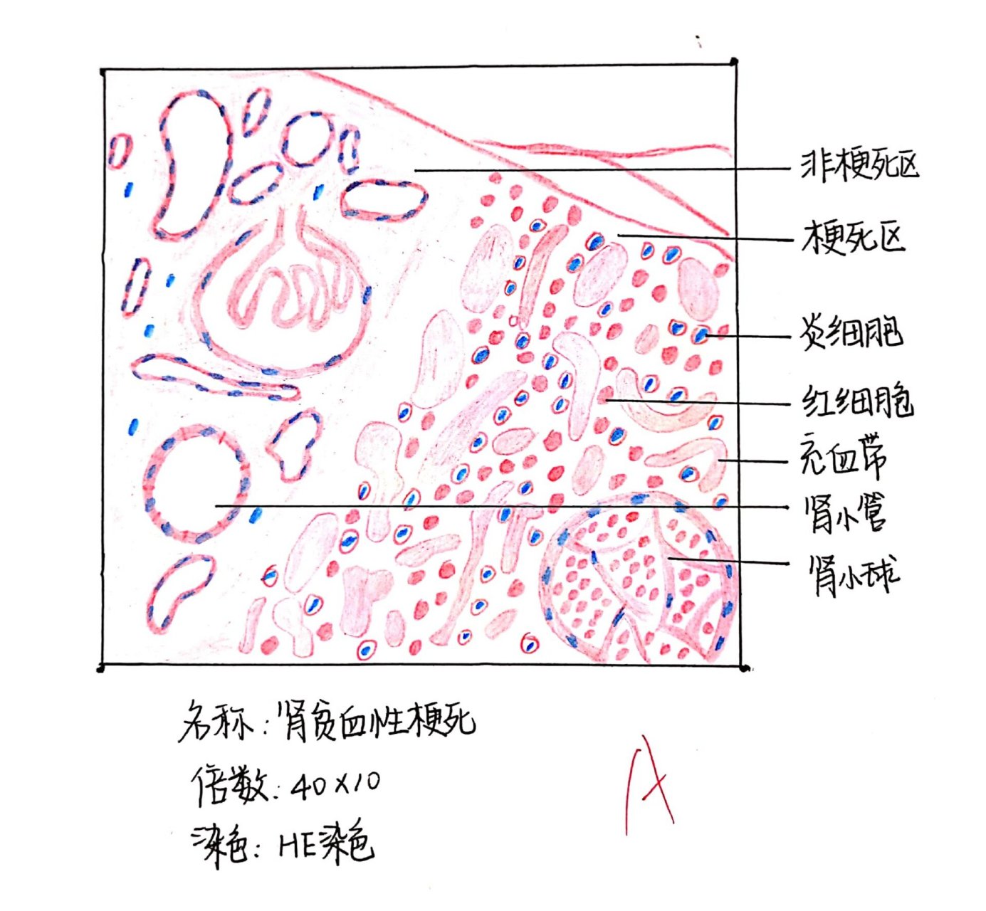 肾梗死病理图片