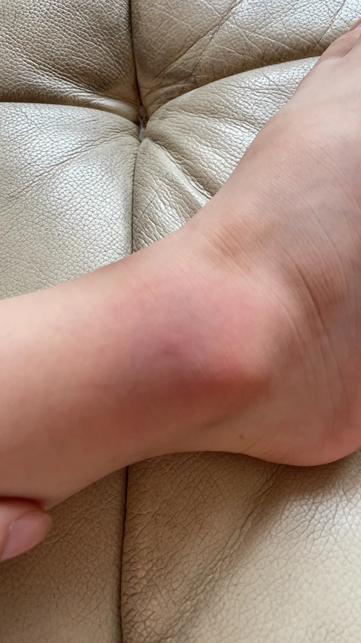 记录一下脚踝扭伤 三岁7个月的娃,特别调皮的年纪,在充气城堡疯狂蹦迪