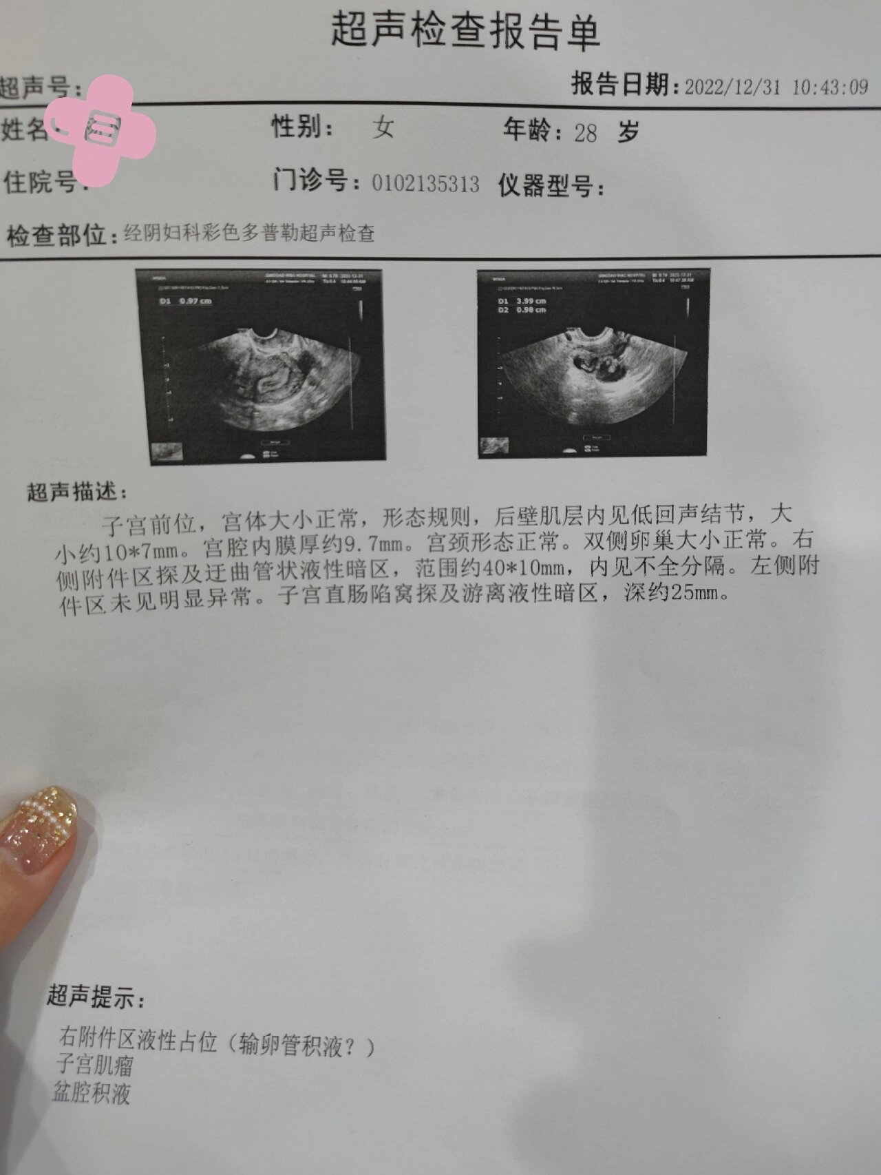 姐妹们有做过输卵管栓塞术的吗?