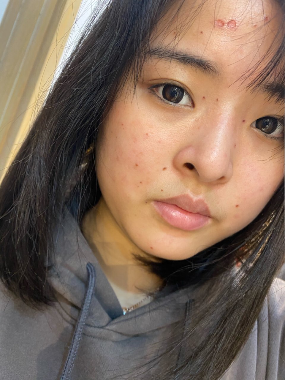扁平疣激光治疗后竟然!