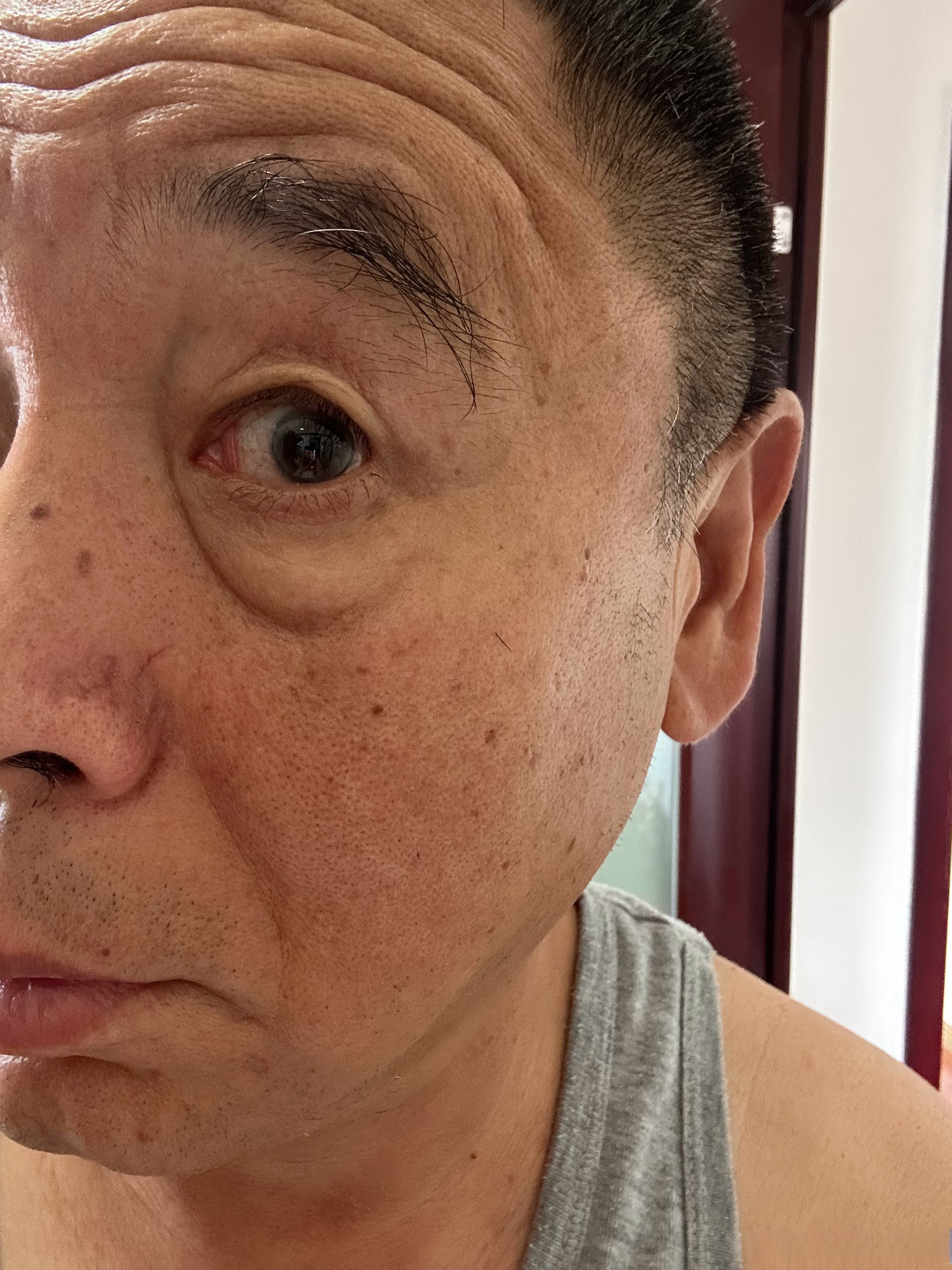 右眼内眼角的褶皱小了,并且褶皱以前是从上到下贯通