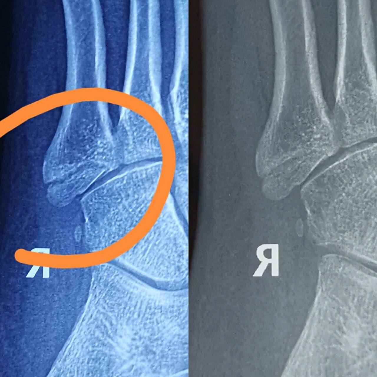 第五趾骨骨折,不疼怎么回事 六月中旬滑滑板摔了一跤,摔的时候特别疼