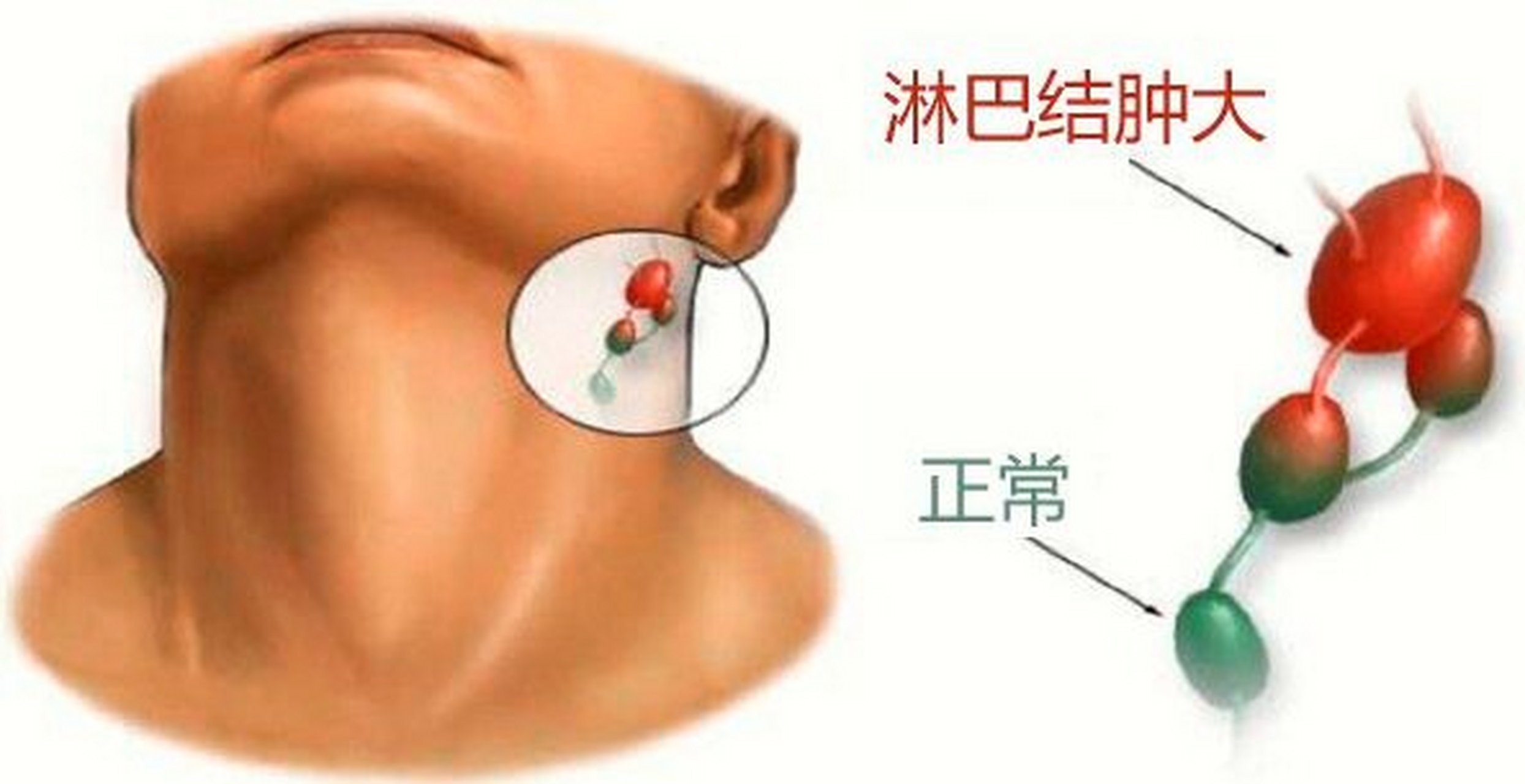 腮腺结节的位置图片图片