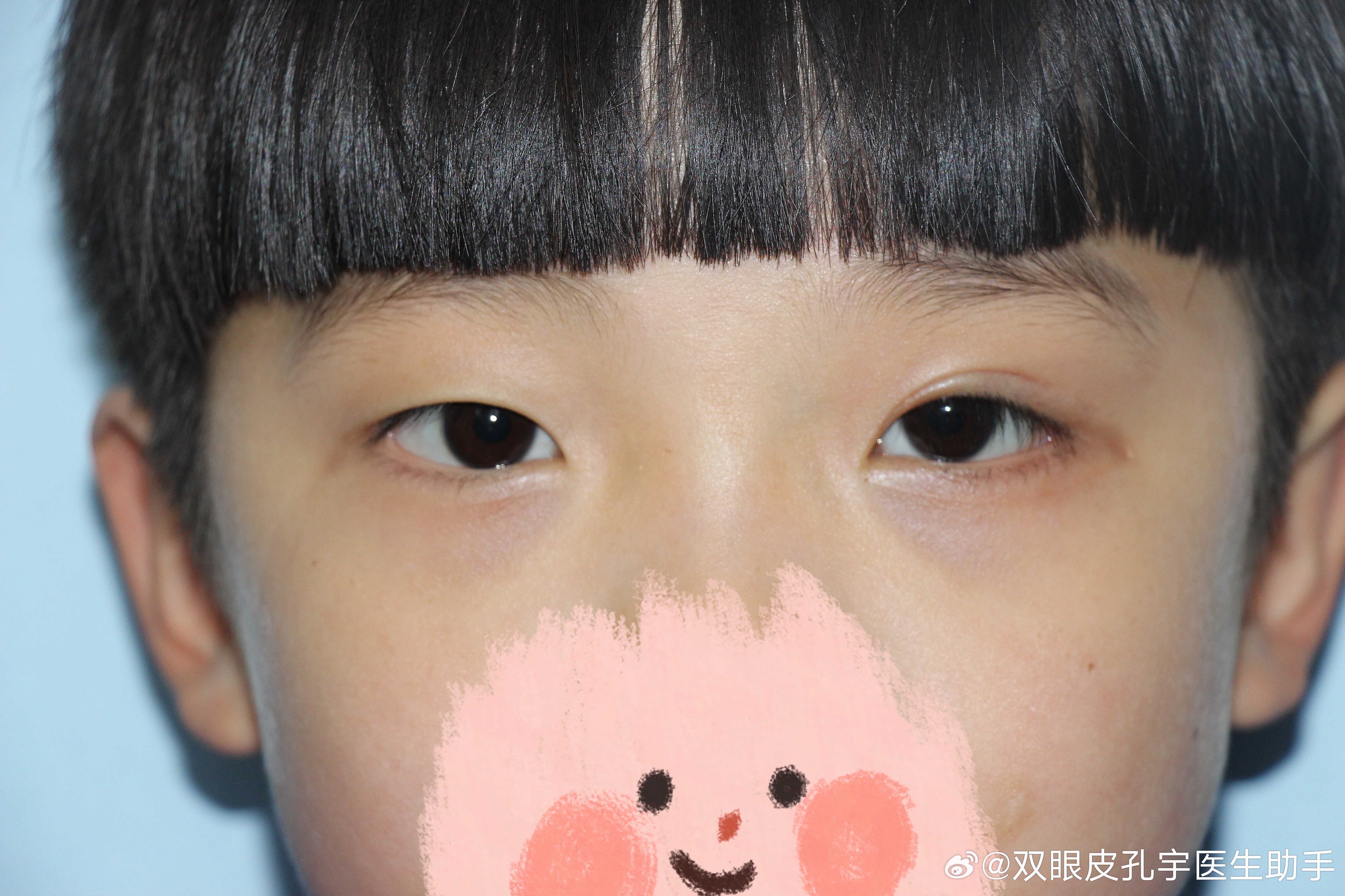 为何儿童一旦发现上睑下垂要尽早干预?