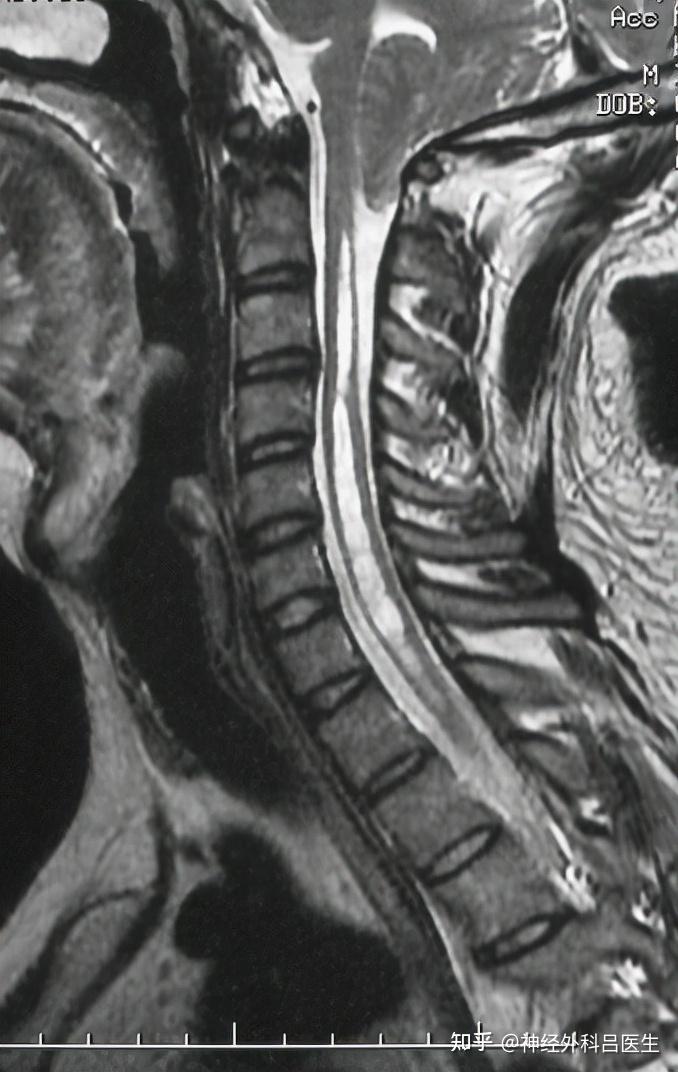 脊髓空洞病图片