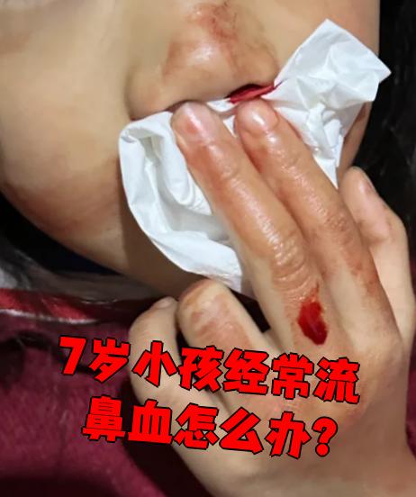 为什么小孩子经常流鼻血