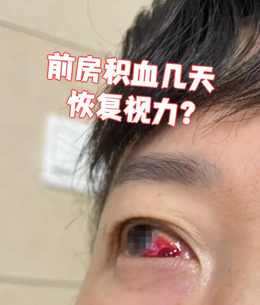 的视力恢复时间因人而异,主要取决于出血量