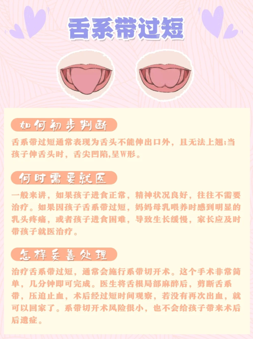 新生儿舌头下面的筋连着舌尖,这种情况叫做舌系带过短