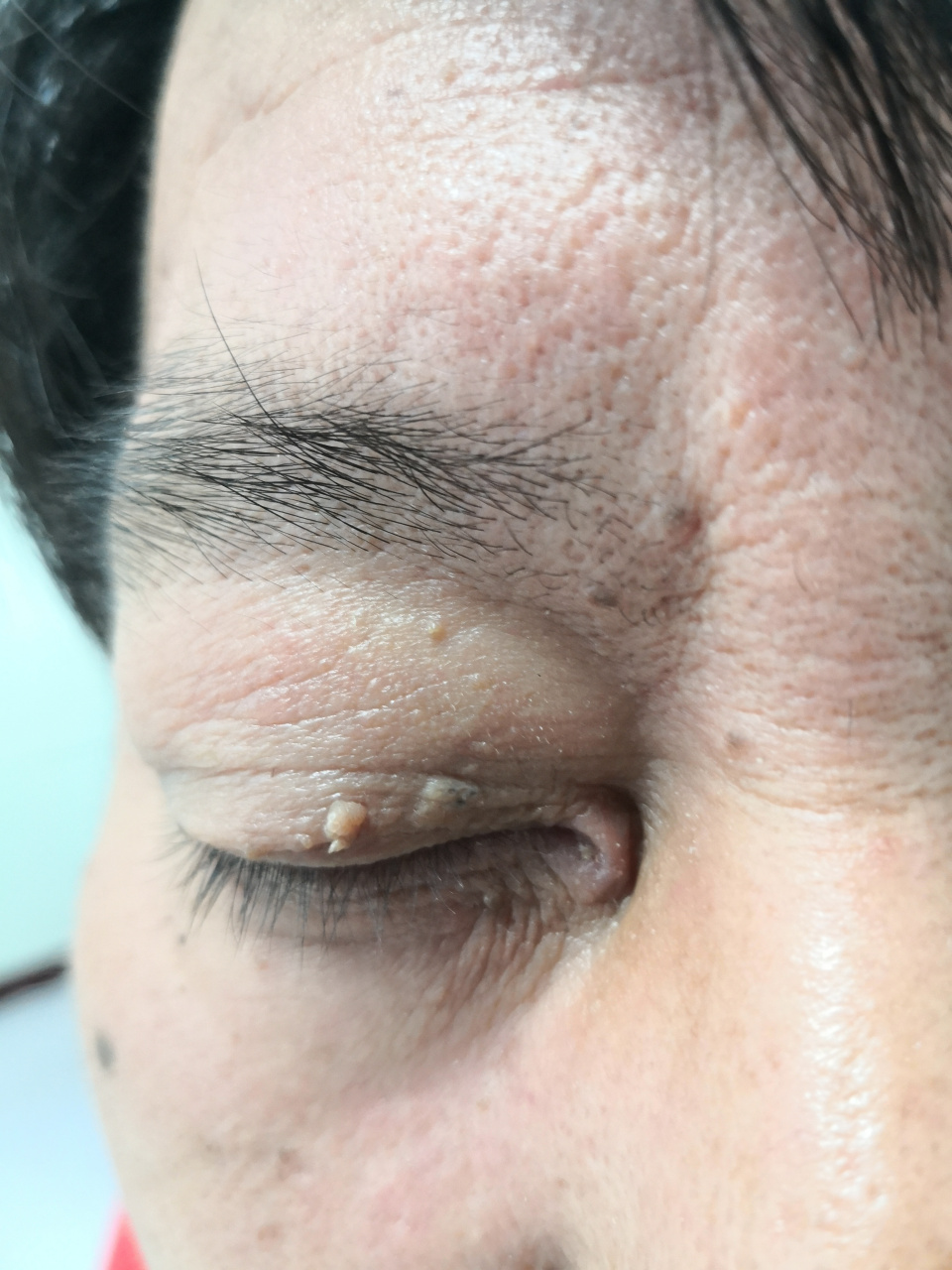 眼睑赘生物和颈周皮赘.