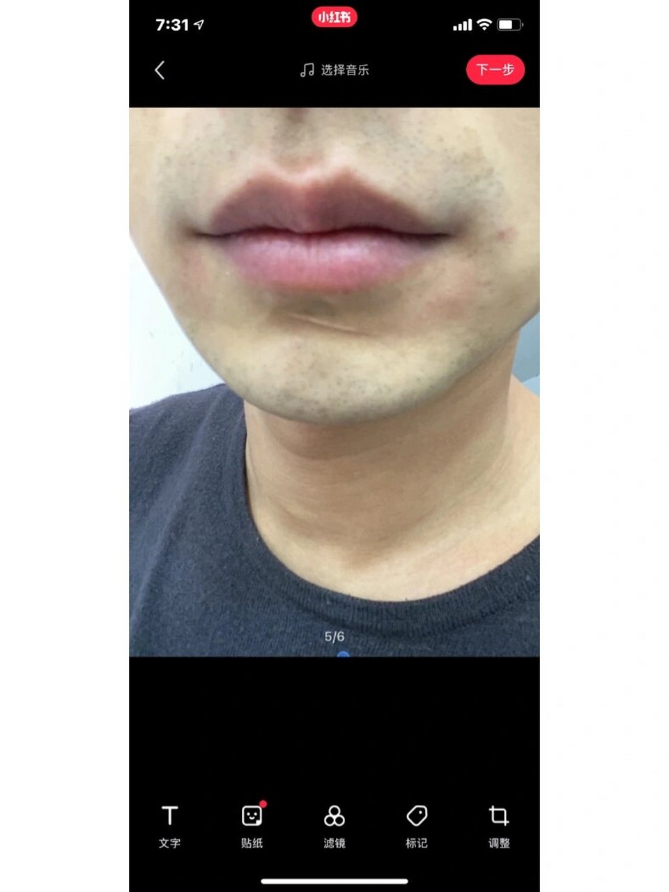 口周皮炎 皮肤病 口周皮炎患者自述 也不知道怎么得上口周皮炎的,突然