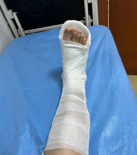 脚踝骨折是越晚落地越好吗为什么在线