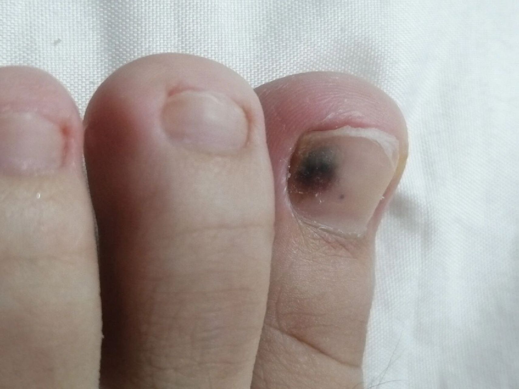 脚指甲黑色素瘤的图片图片