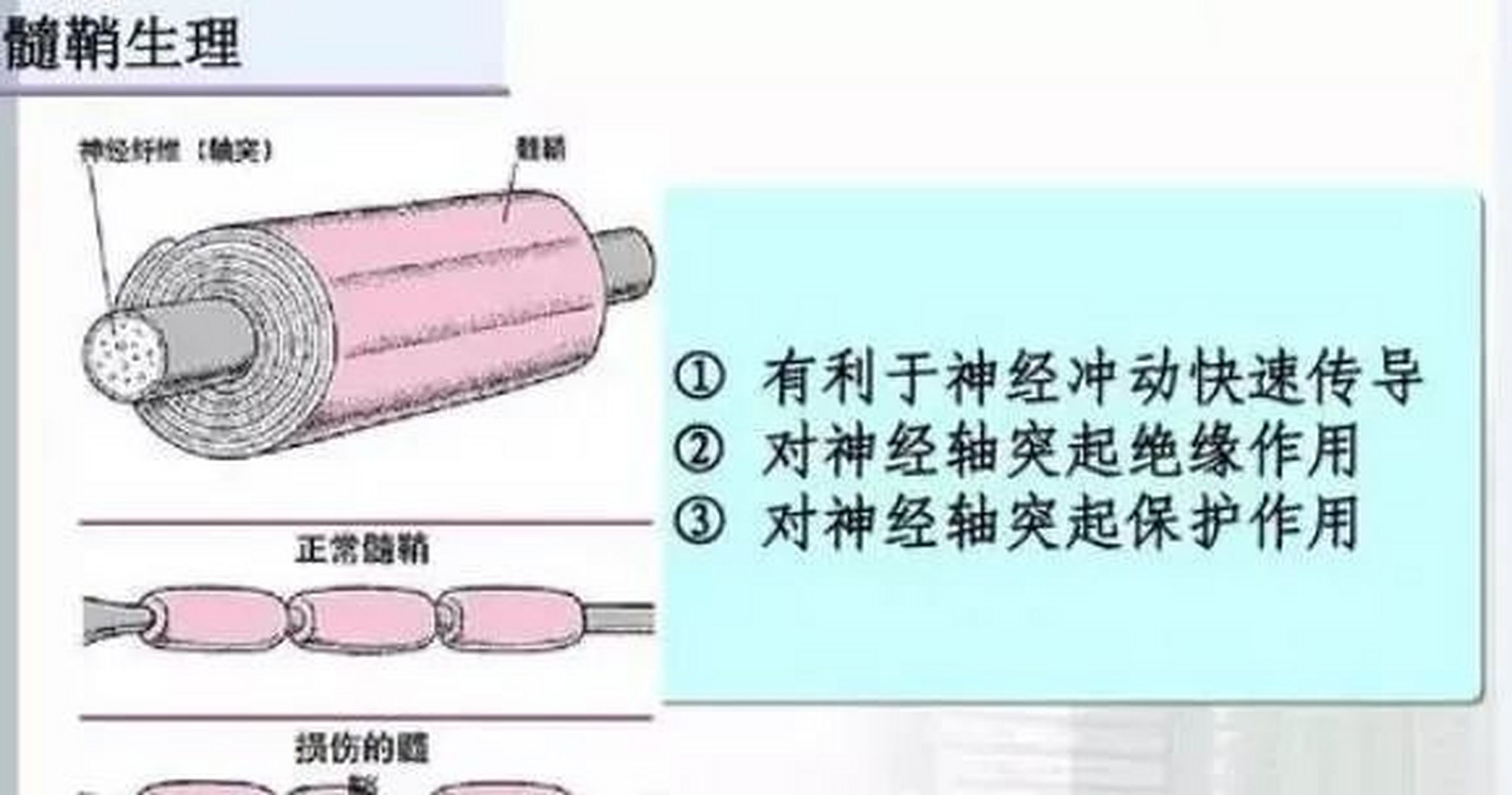 让人恐惧的"脱髓鞘"是什么 正确认识"脱髓鞘".