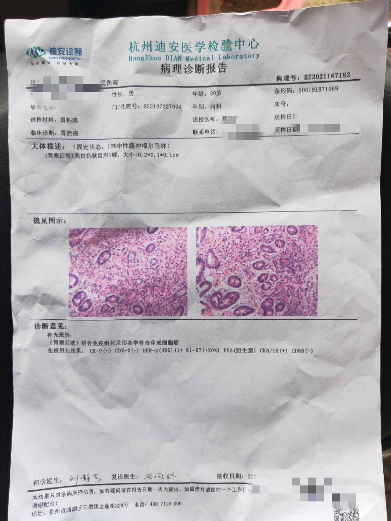 胃体小弯低分化腺癌图片