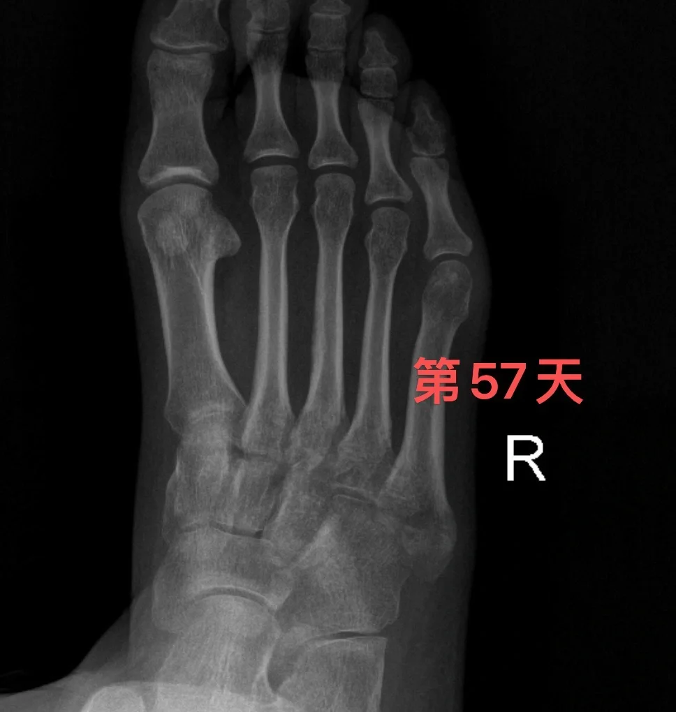 第五跖骨基底骨折第57天