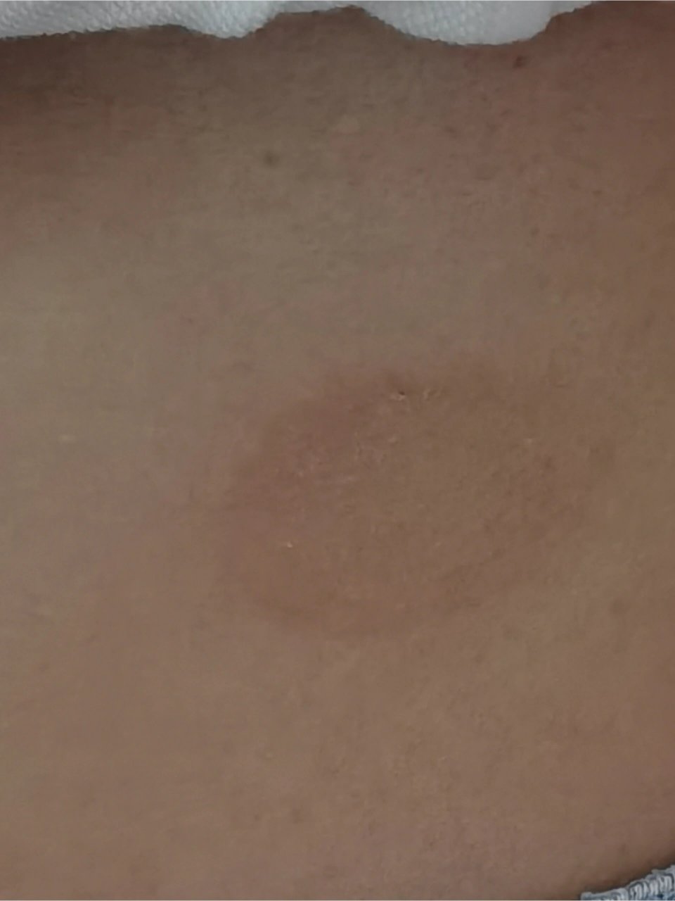 身上突然有了这样一个圆圈  不疼不痒  蜕皮是怎么回事啊 一开始是