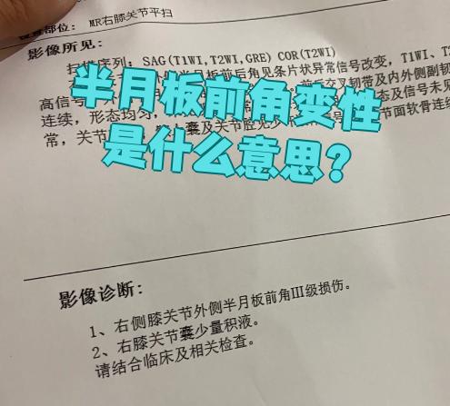半月板前角变性指的是半月板前角的结构出现异常变化,导致组织损伤