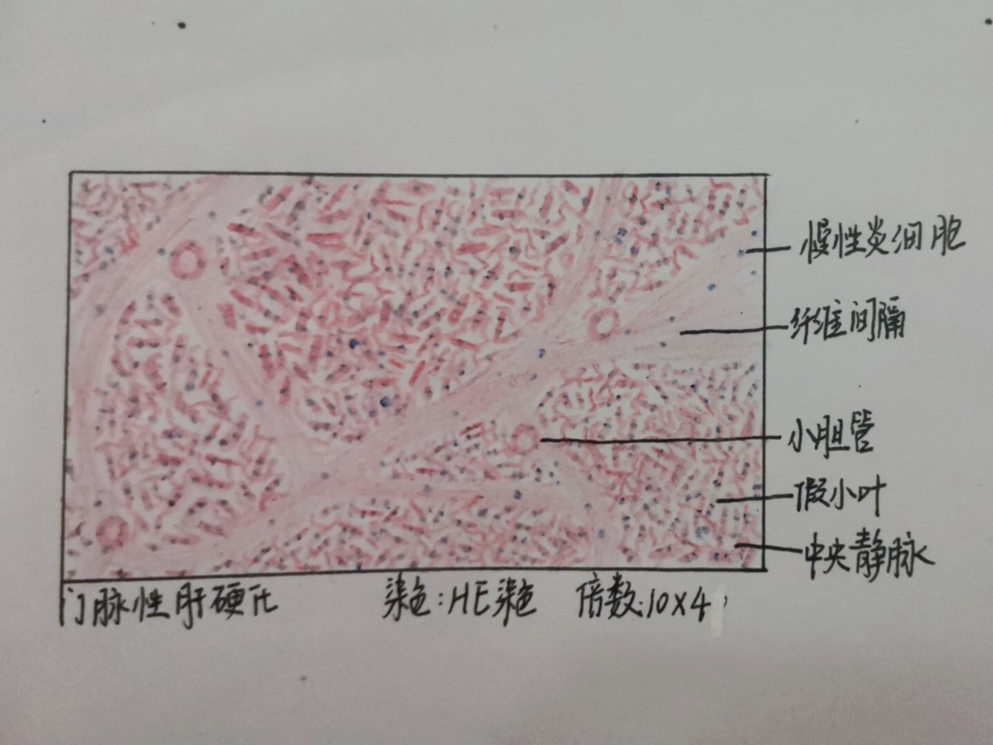 肝硬化病理切片手绘图图片