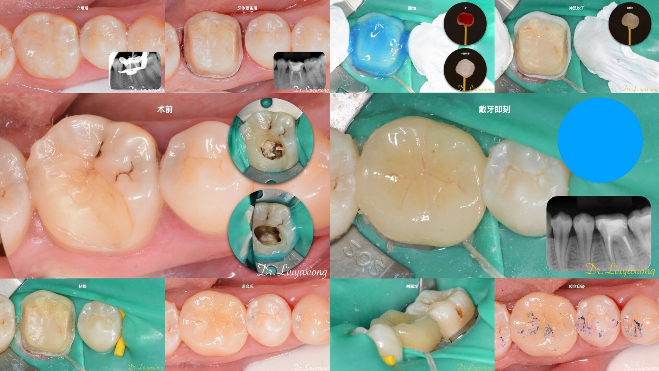 根管再治疗 高嵌体修复一例 不完善的治疗远期效果不佳; 标准化根管