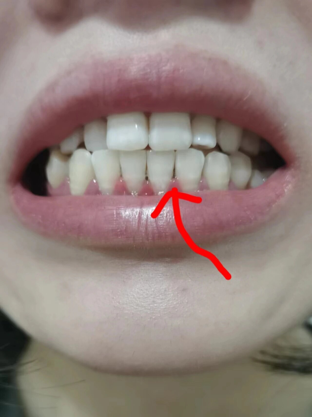 前段时间牙齿一吃冷的,酸的,热的和甜的就会有刺痛感,而且