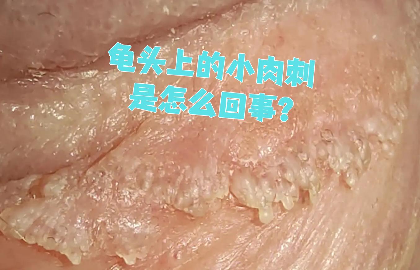 龟头上出现小肉刺可能是正常现象,也可能是感染引起的