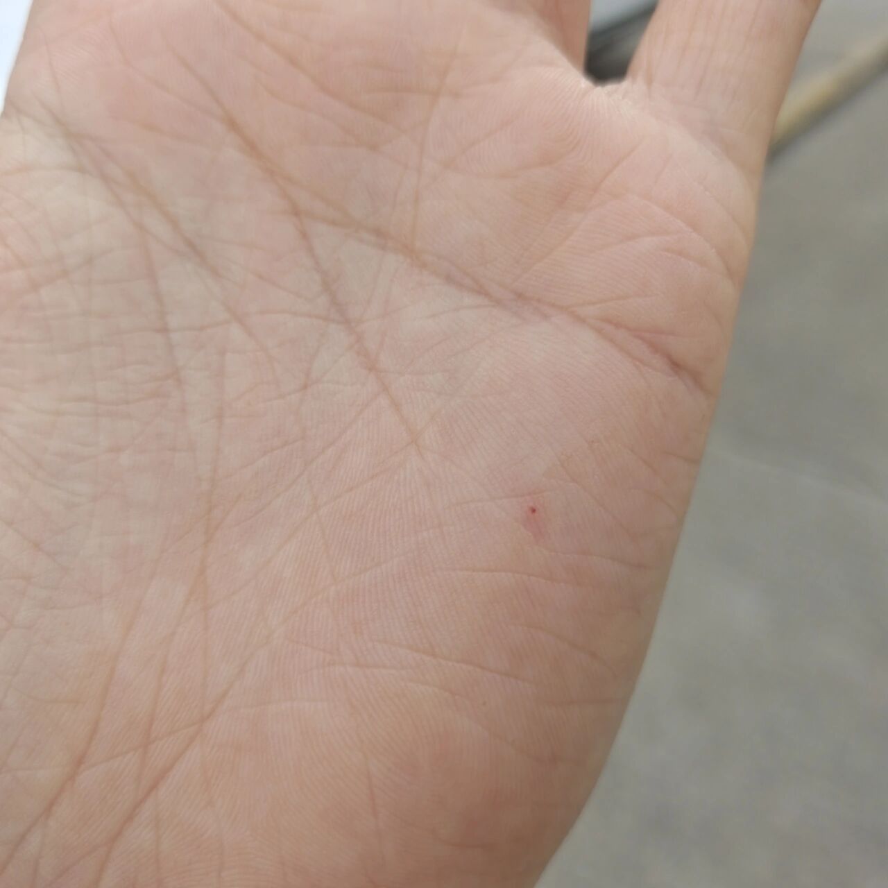 手掌上突然出现了一个红点 左手手掌上突然出现了一个红点,不痛不痒
