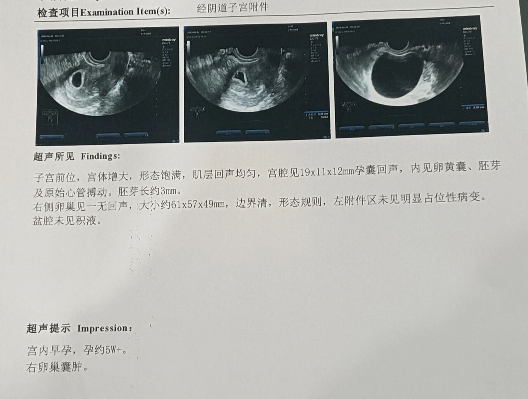 怀孕后检查出有卵巢囊肿 怀孕前做彩超都没啥问题,怀孕后发现有卵巢